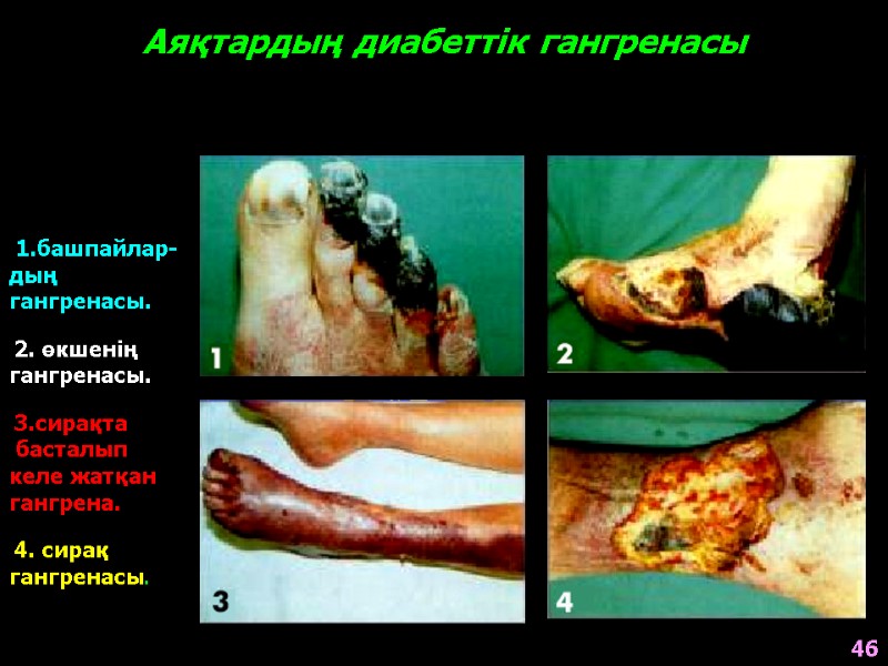 Аяқтардың диабеттік гангренасы   1.башпайлар- дың  гангренасы.   2. өкшенің 